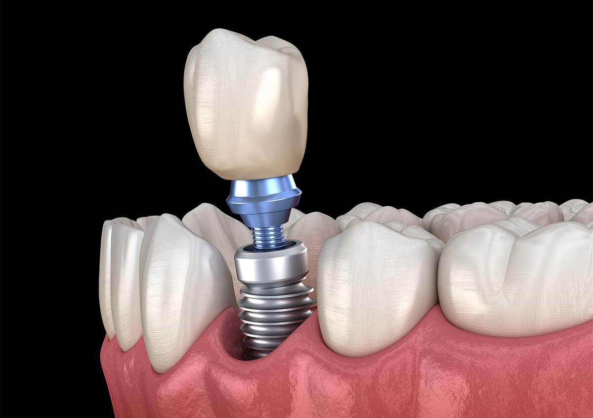 Are Dental Implants Permanent in Meridian ID Area