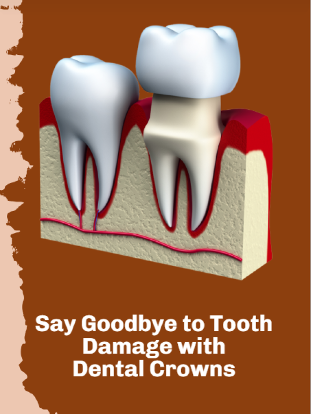 Say Goodbye to Tooth Damage with Dental Crowns
